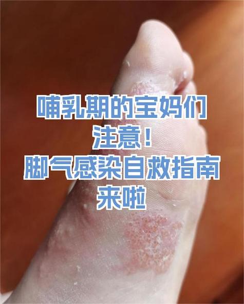 哺乳期妈妈怎么去脚气缩略图