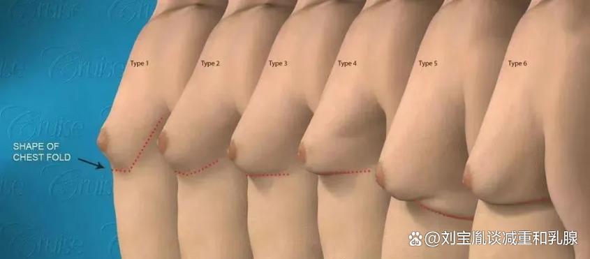 乳房各种形状图片大全