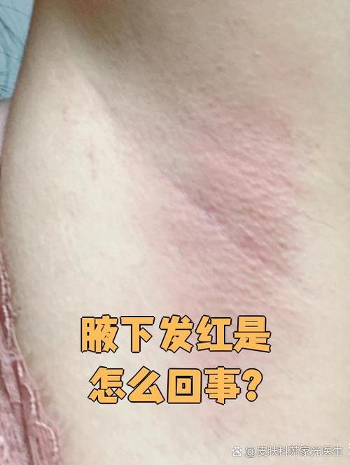 胳肢窝发红发痒是怎么回事游戏截图