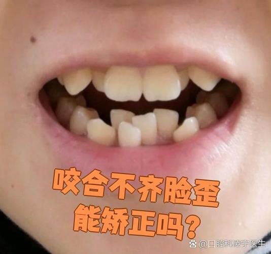 左右牙齿不一样多嘴歪缩略图