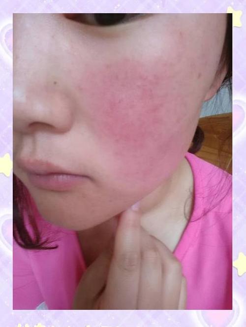 防晒霜过敏脸上红肿发痒如何治疗缩略图