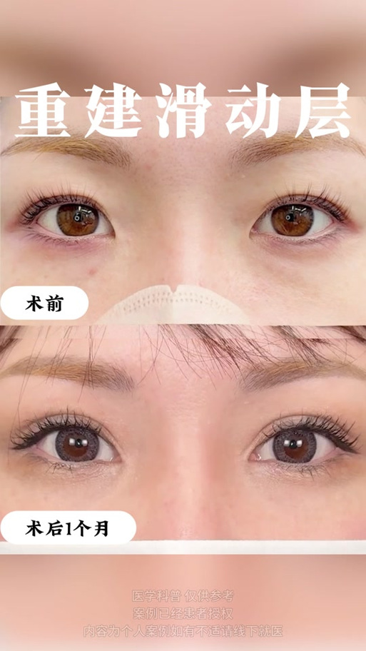 仿生双眼皮是永久的吗缩略图
