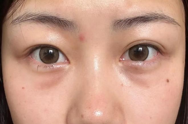 打针去眼袋能保持多久缩略图