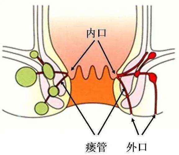 肛门漏屎怎么治游戏截图