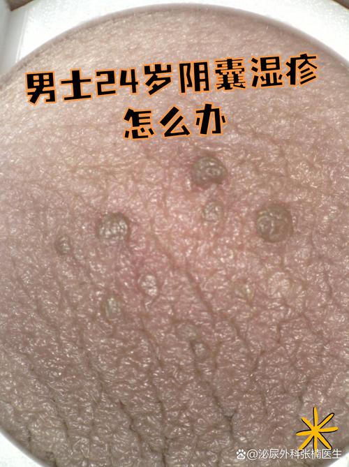 阴囊瘙痒最佳药膏