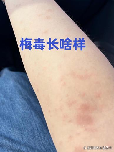 女人染梅毒后两大特征