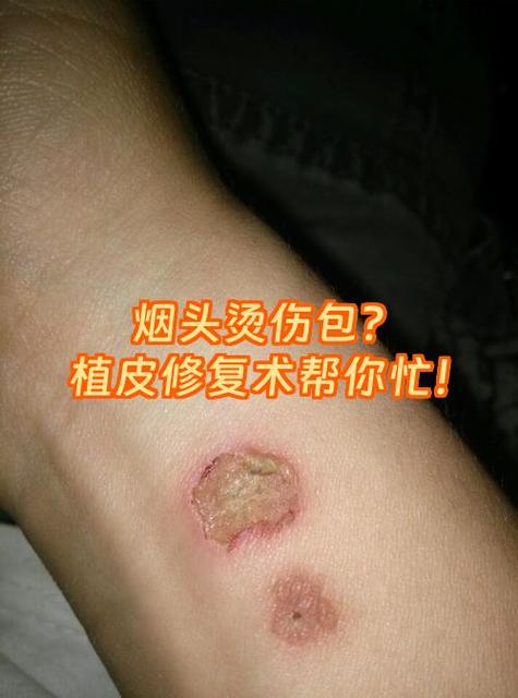 烫伤后皮肤发红多久能恢复呢?