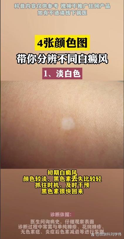 正常人白斑图片