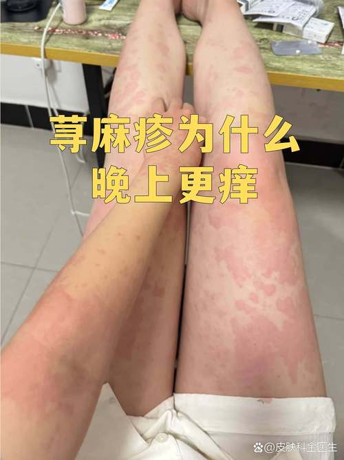 为什么过敏一到晚上就严重