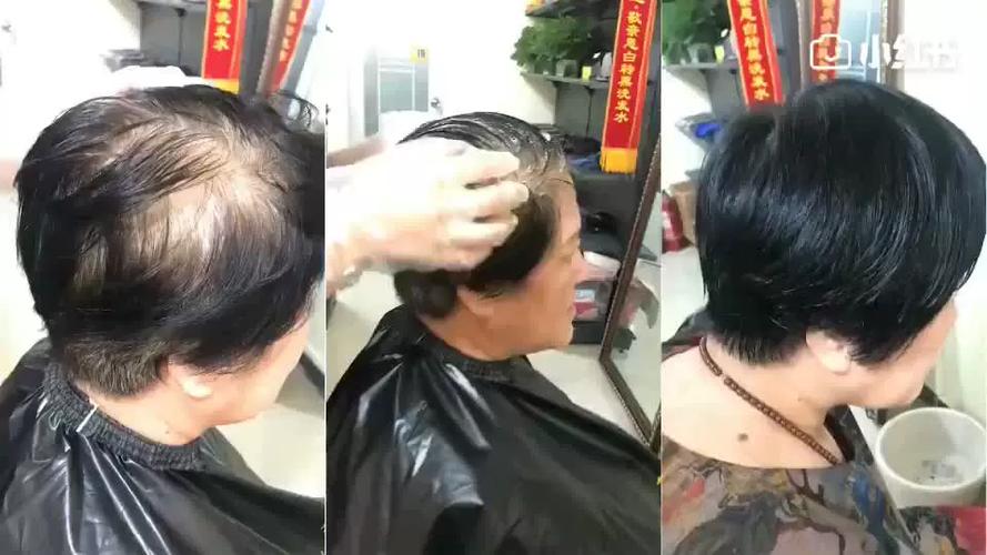 毛囊一旦白发能变黑吗