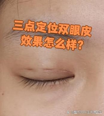 三点双眼皮能维持几年缩略图