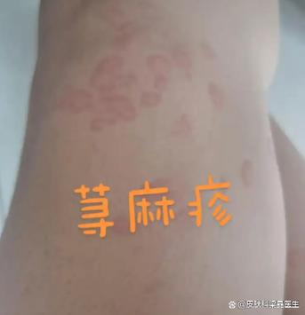 皮肤病100种图片缩略图