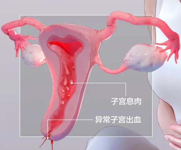 子宫息肉为什么不建议切除游戏截图