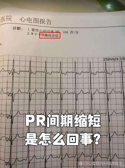 心电图pr间期短严重吗图标