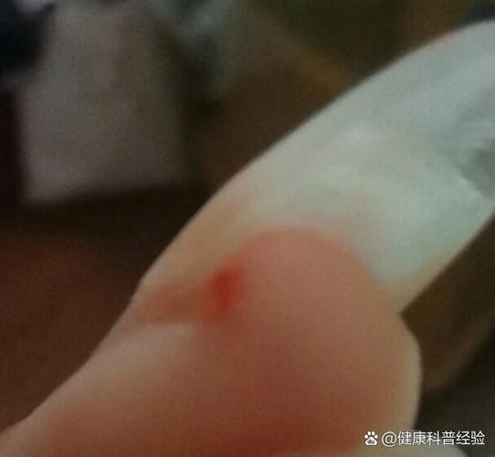 被金丝熊咬了得狂犬病的案例图标