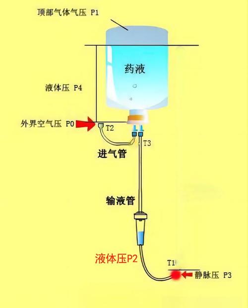 吊针原理示意图