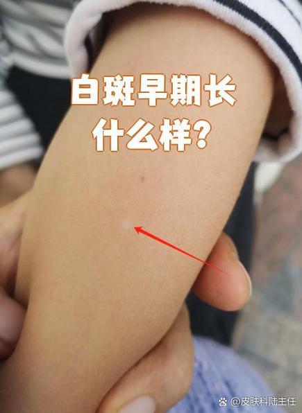 皮肤上的白色斑点是什么