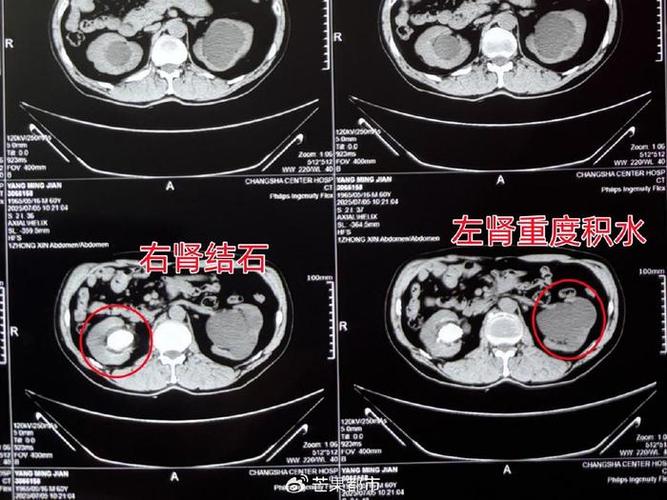 双肾ct平扫能检查出什么