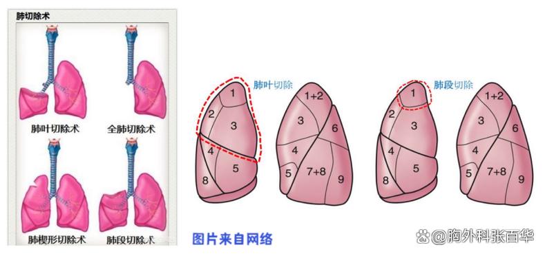 肺结节吃什么药好得快效果最好