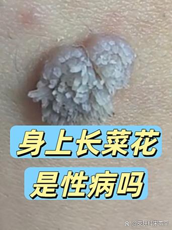 疣会自己消失吗图标