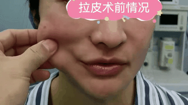 脸部松弛下垂怎么恢复