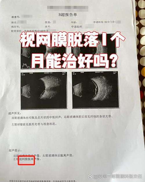 视网膜脱落能治好吗图标