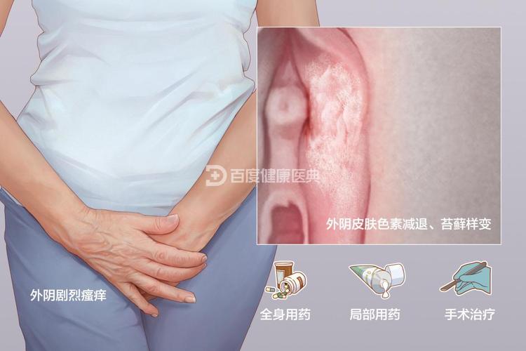 女性外阴白斑用什么药