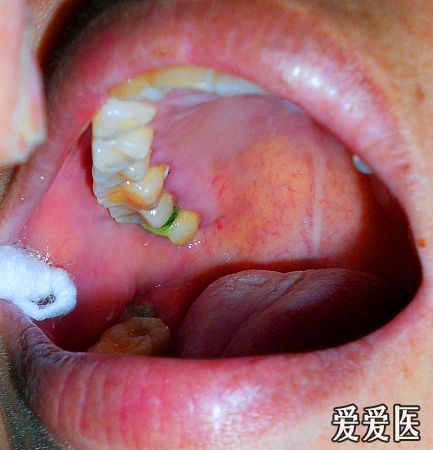 皮肤出现红色斑块