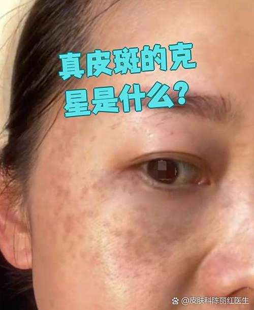 长斑图片