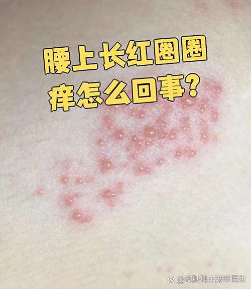 女性右侧腰痒要警惕