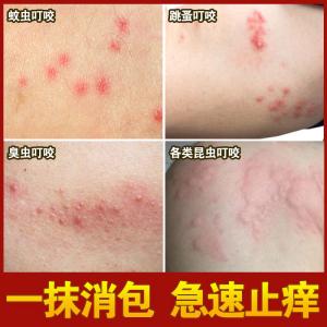 臭虫咬了最怕三样药膏图标