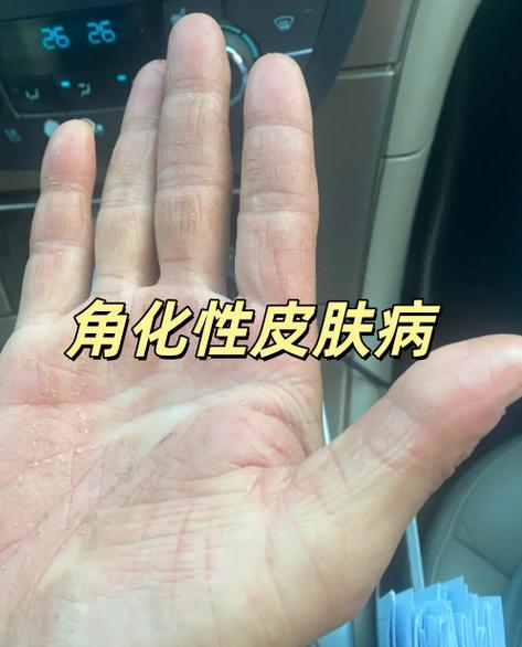 皮肤角质化图片缩略图