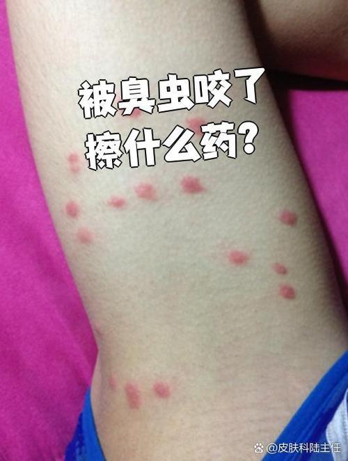 臭虫咬了红肿痒怎么办用什么药缩略图