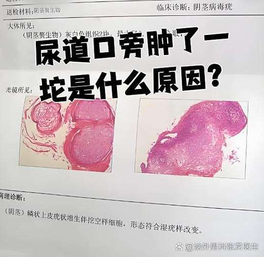 尿道口肿胀图片图标