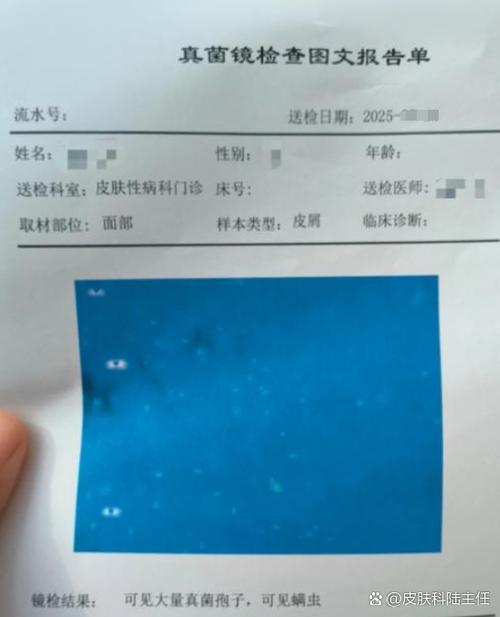 鼻子旁边长癣了怎么办