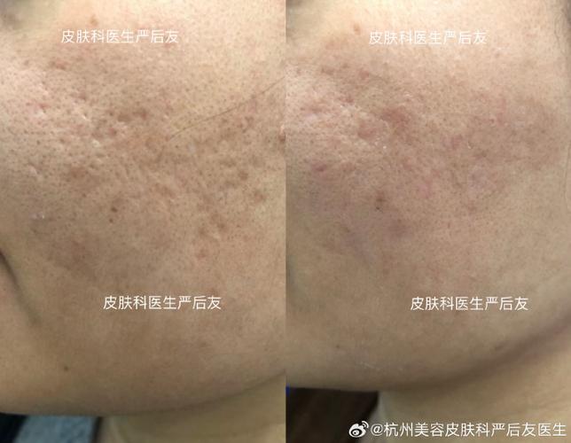 有痘印怎么去除图标