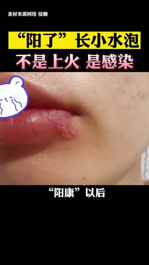 阳了得症状是什么缩略图