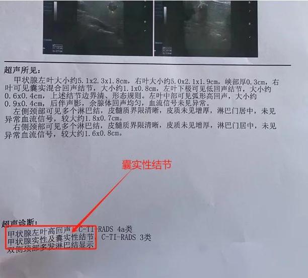 彩超单上hc是什么意思