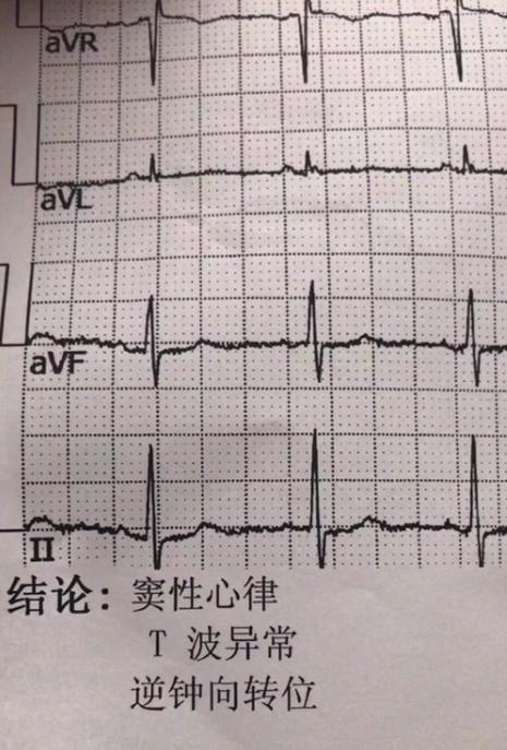 逆钟向转位 会猝死吗图标