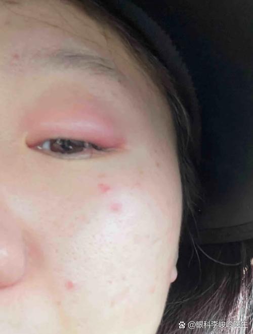 眼部过敏红肿痒怎么办缩略图