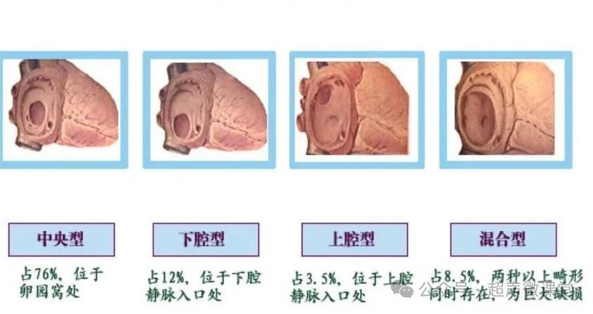 房间隔发育薄弱的影响