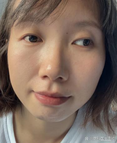 眼睛看东西斜是怎么回事
