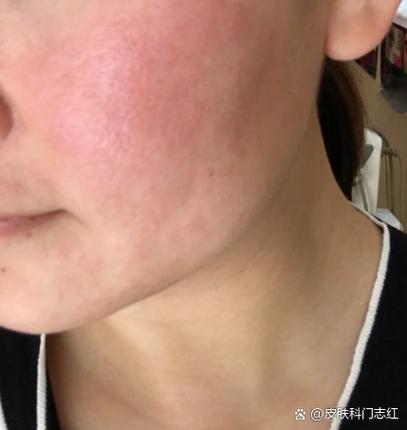 脸过敏发红痒擦什么药缩略图
