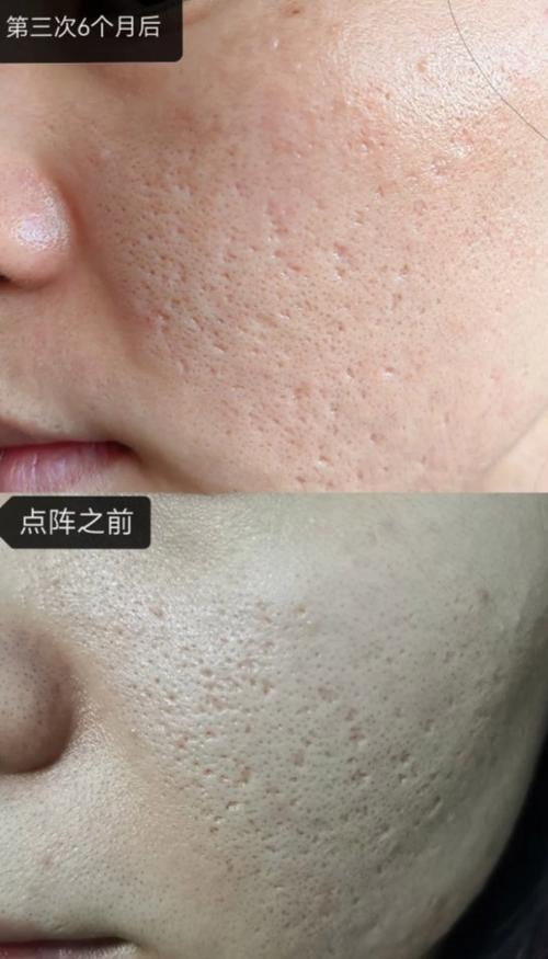 痘坑怎么才能恢复图标