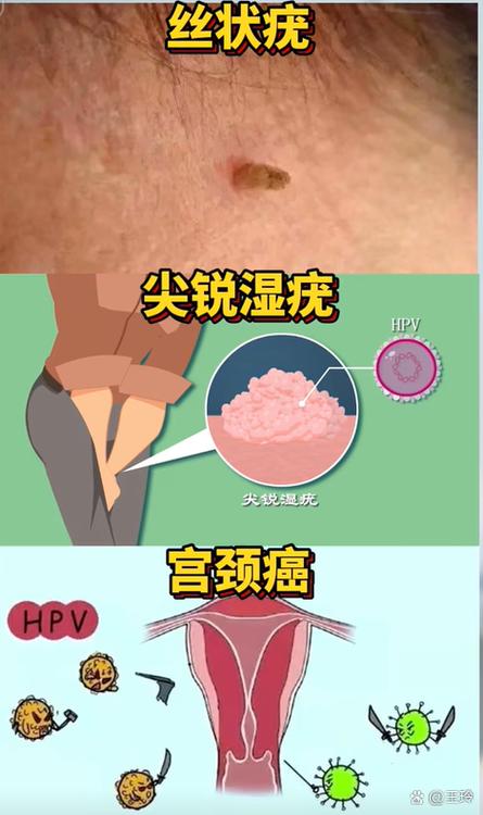人乳瘤病毒感染是什么病缩略图