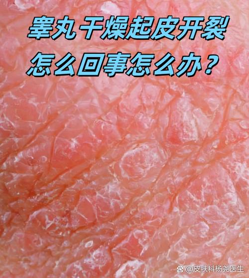 睾丸脱皮痒干燥起鳞片是什么原因缩略图