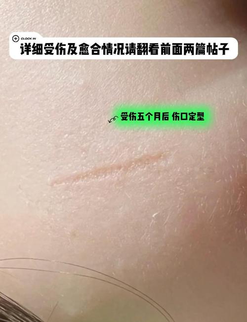 伤口反复挠破