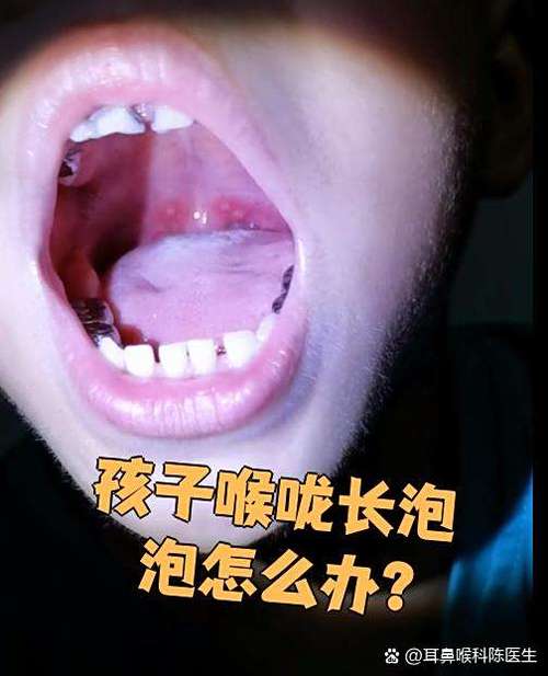 嗓子有小泡泡是病毒吗缩略图