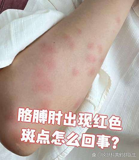 皮肤起红斑发痒怎么办缩略图
