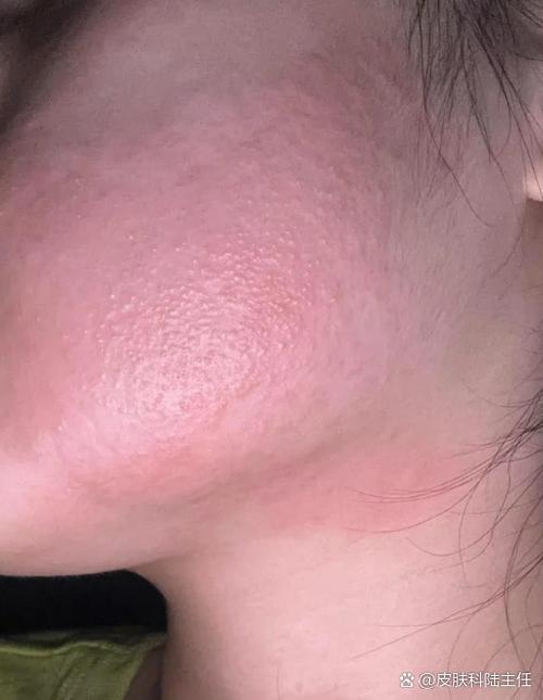 脸皮过敏发痒抹什么药